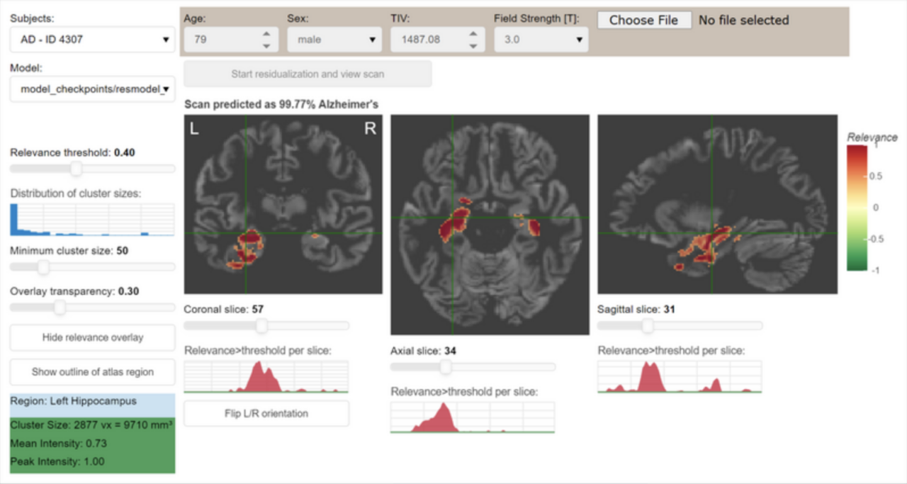 Artificial Intelligence detects Alzheimer early