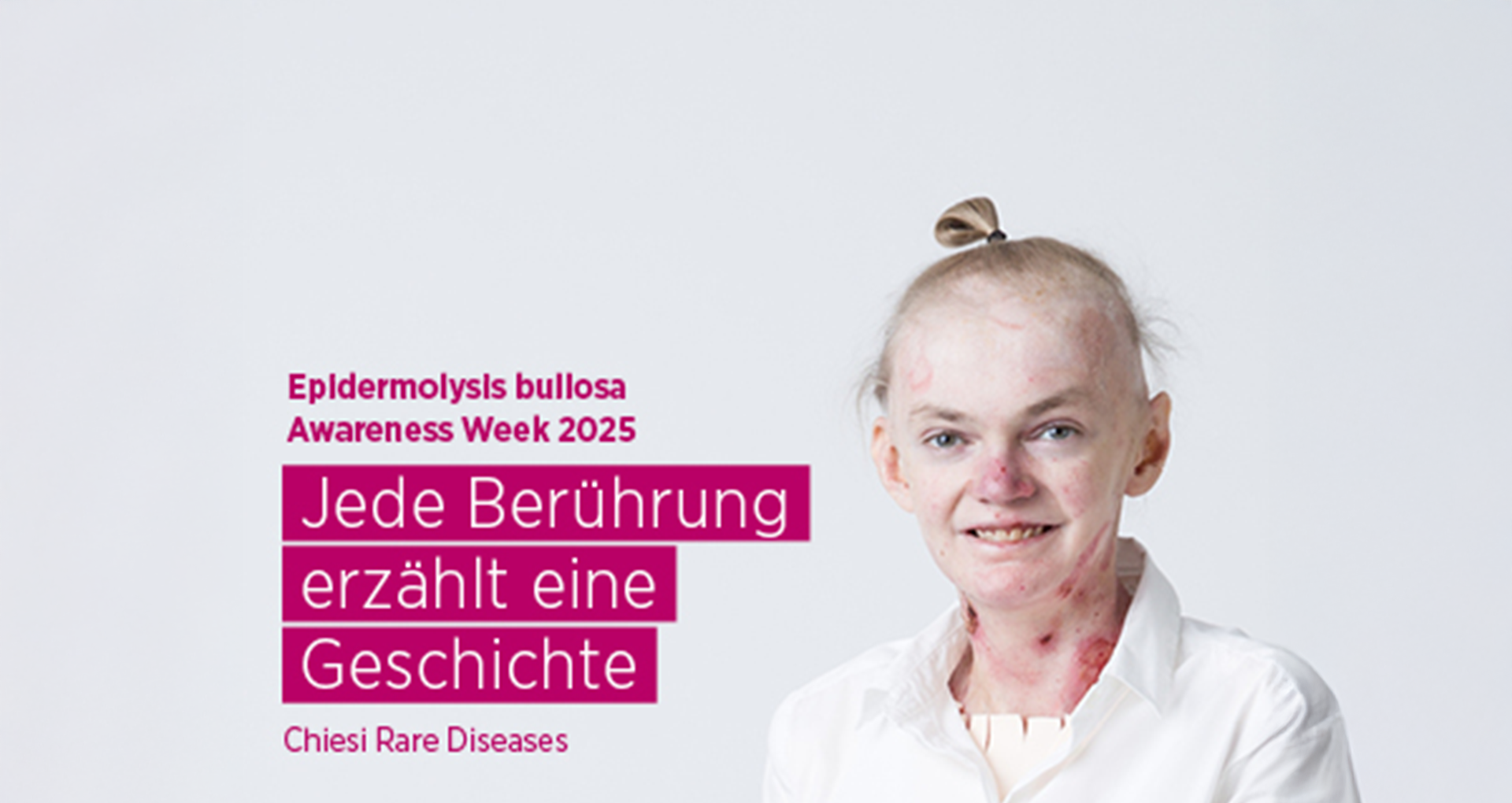 Chiesi setzt Zeichen zur EB Awareness Week